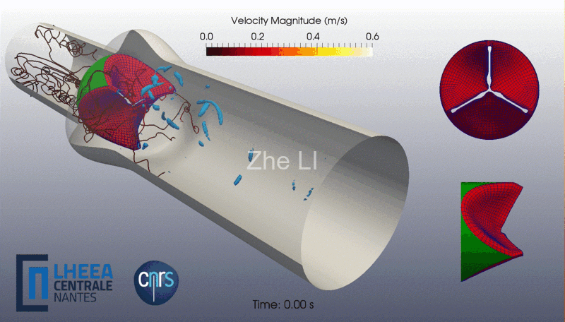 blood-valve interaction with LBM-FEM coupling
